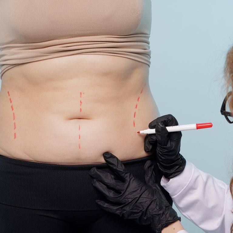 Close up of doctor drawing marks on woman body before plastic surgery. Patient in black underwear standing in front of surgeon while man drawing line on her bare skin. Concept of plastics surgery.