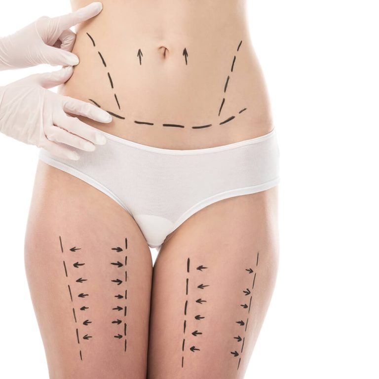 The Power of a Tummy Tuck and Thigh Lift 10 Results You'll Love